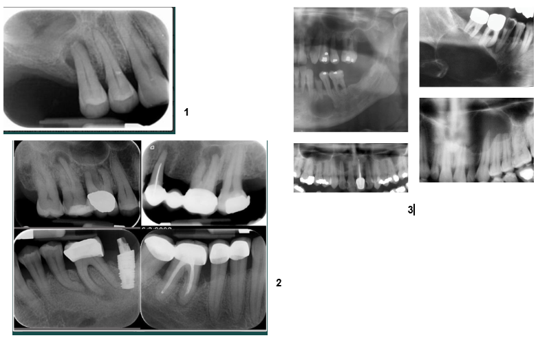 <p>inflammatory RL lesions&nbsp;</p><p>all periapical RL linked with non vital teeth=necrosis</p><p>can’t definitively differentiate radiographically</p><p>radiographic tendencies (not diagnostic)</p><ul><li><p>abscess-PDL widening, diffuse borders</p></li><li><p>granuloma-small, well defined RL&nbsp;</p></li><li><p>cyst-larger, may show corticated border</p></li></ul><p>diagnosis requires clinical tests (vitality testing) and/or biopsy&nbsp;</p><p></p>