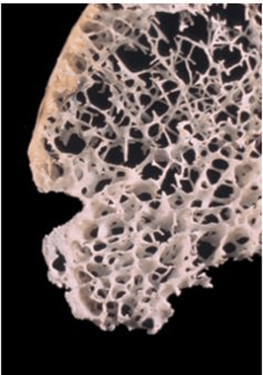 <p>Severely decreased bone mass</p><p>Increased susceptibility to fractures</p><p>Bone density > 2.5 SD below young adult reference population</p><p>>1 to 2.5 SD below is osteopenia without osteoporosis</p><p>risk factors:</p><p>Personal Characteristics</p><p>Advanced age</p><p>Females</p><p>Ethnicity (white or Asian)</p><p>Small bone structure/low body weight Postmenopausal</p><p>Family history</p><p>Lifestyle (modifiable)</p><p>Sedentary</p><p>Calcium/Vitamin D deficiency</p><p>Malnutrition Smoking</p><p>Excessive alcohol intake</p><p>Excessive caffeine intake (*)</p><p>Medications</p>