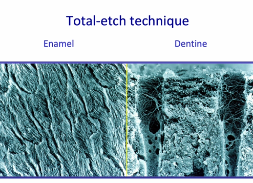 <p>a very rough / porous technique at a microscopic level in both enamel and dentine&nbsp;</p>