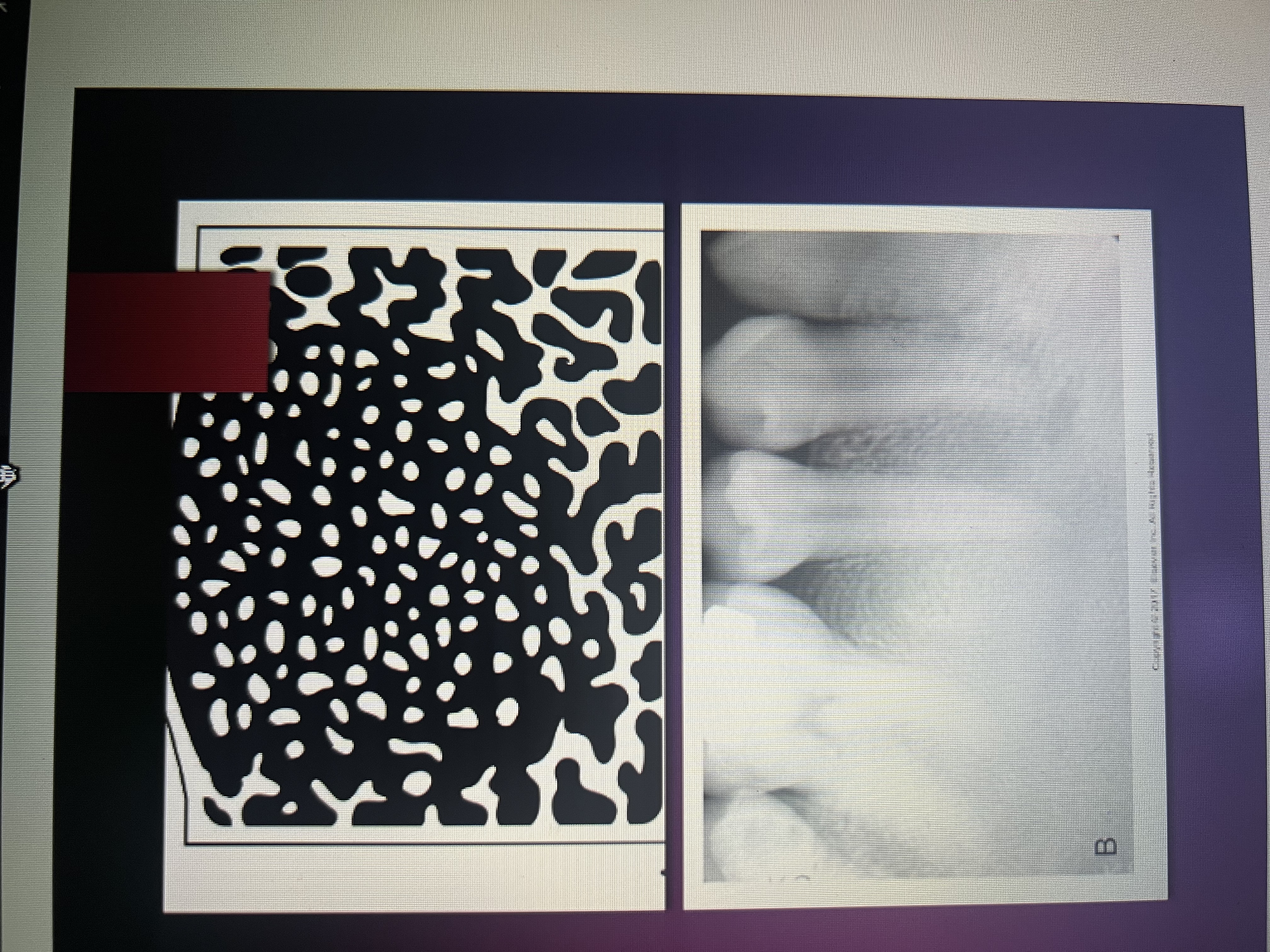 <p>radiopaque/ground glass opacity</p>