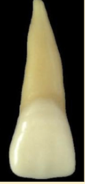 <p><mark data-color="blue" style="background-color: blue; color: inherit">maxillary central incisors #8 and #9; mesial edge</mark></p>