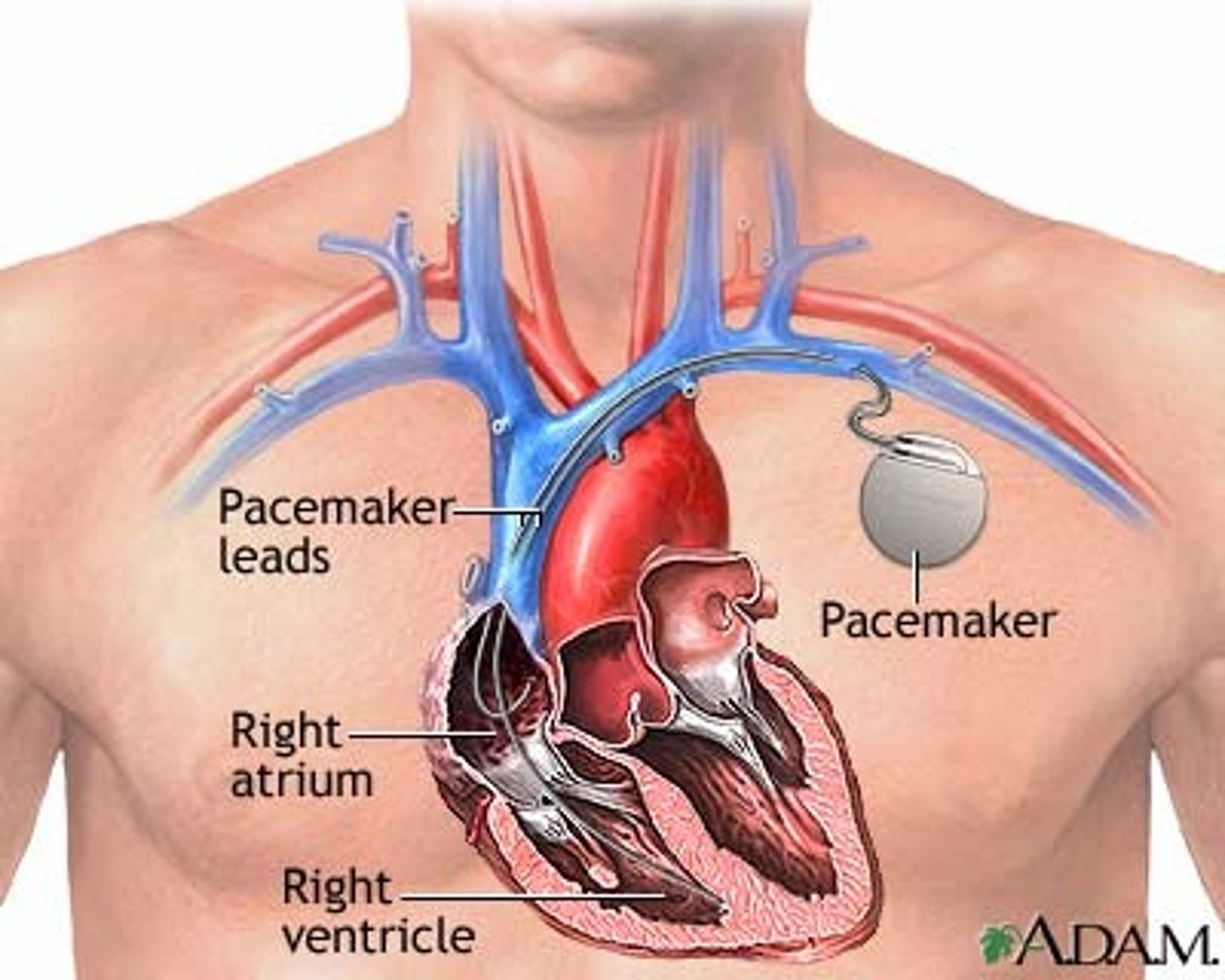 <p>delivers electrical impulses to heart to regulate heart rate<br>- lead fed through vein to right atrium<br>- detect missed heartbeat</p>