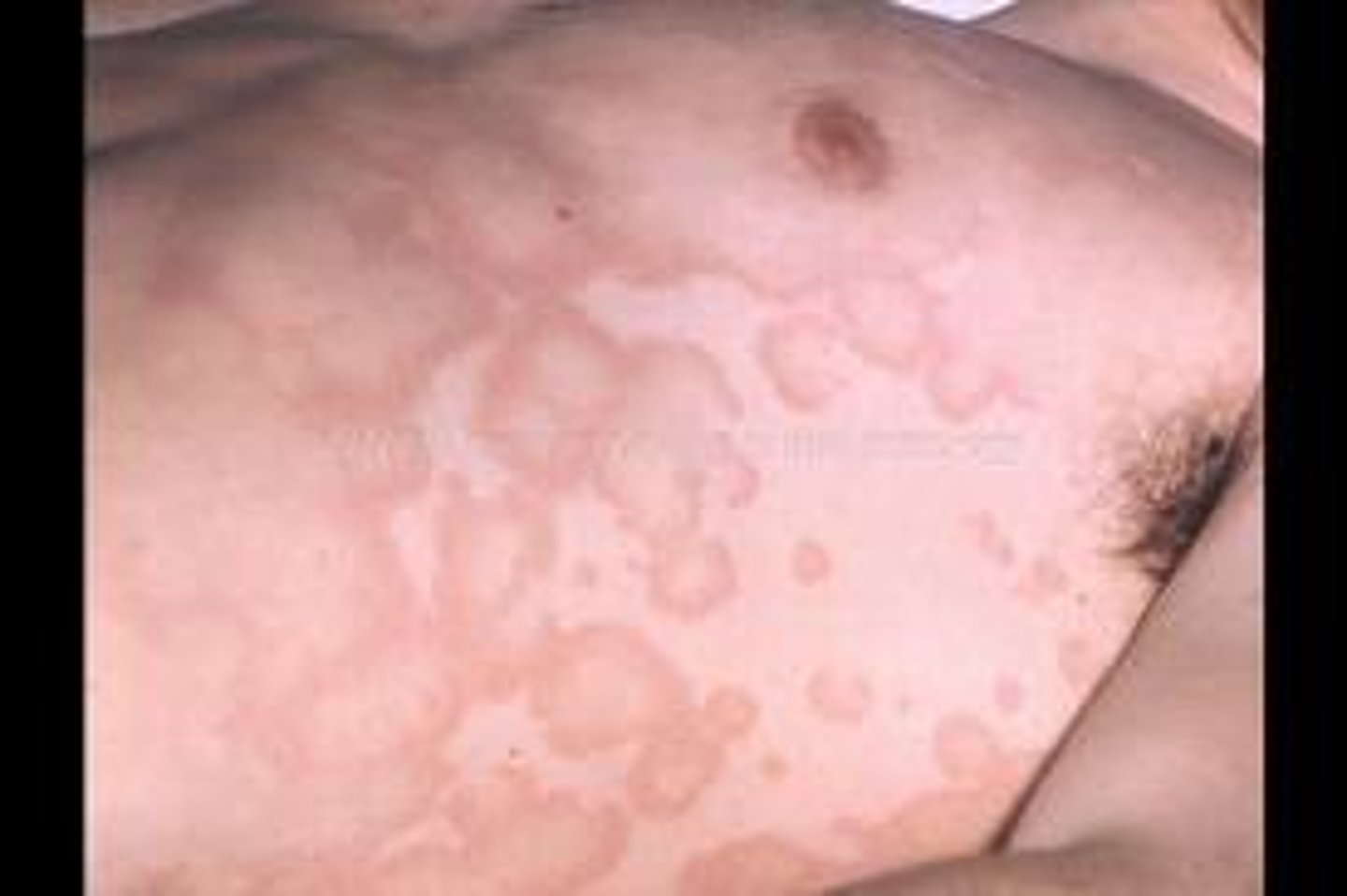 <p>rash, pink, non-pruritic macules that never occur on the face or the hands</p>