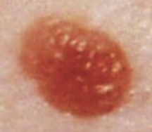 <p>Lesion that comes in a variety of shapes and colors; present at birth.</p><p>(Ex. mole, birthmark, port-wine stain)</p>