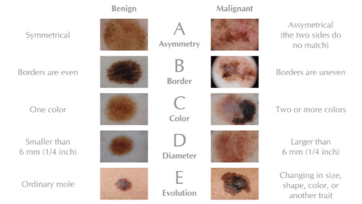 <p>ABCDEFG's:</p><p>◦Asymmetry</p><p>◦Border irregularity</p><p>◦Color variation</p><p>◦Diameter &gt; 6 mm, bigger than an eraser</p><p>◦Evolution/Elevation, changed overtime?</p><p>◦Family history of melanoma, Firm to Palpation</p><p>◦Growing progressively</p>