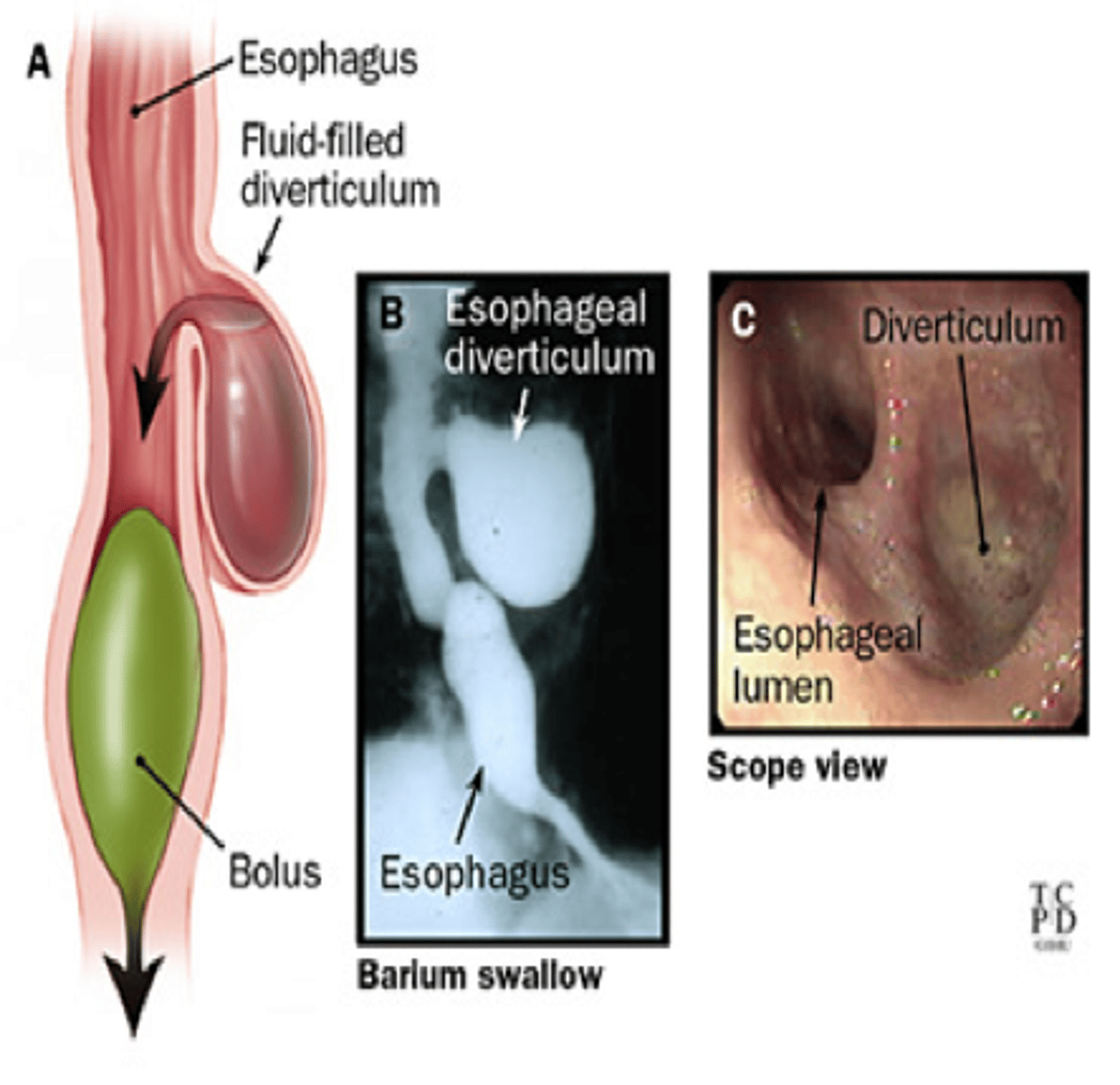 <p><strong>esophageal diverticula</strong></p>
