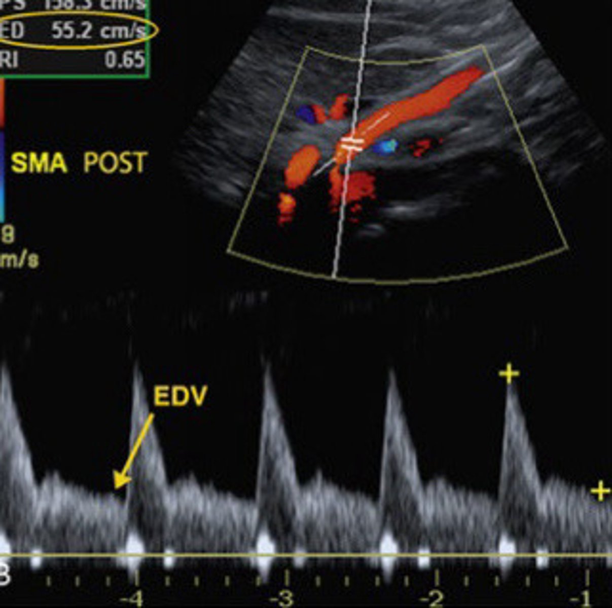 <p>Is this image taken form the SMA most likely from a patient who is pre-prandial or post-prandial</p>