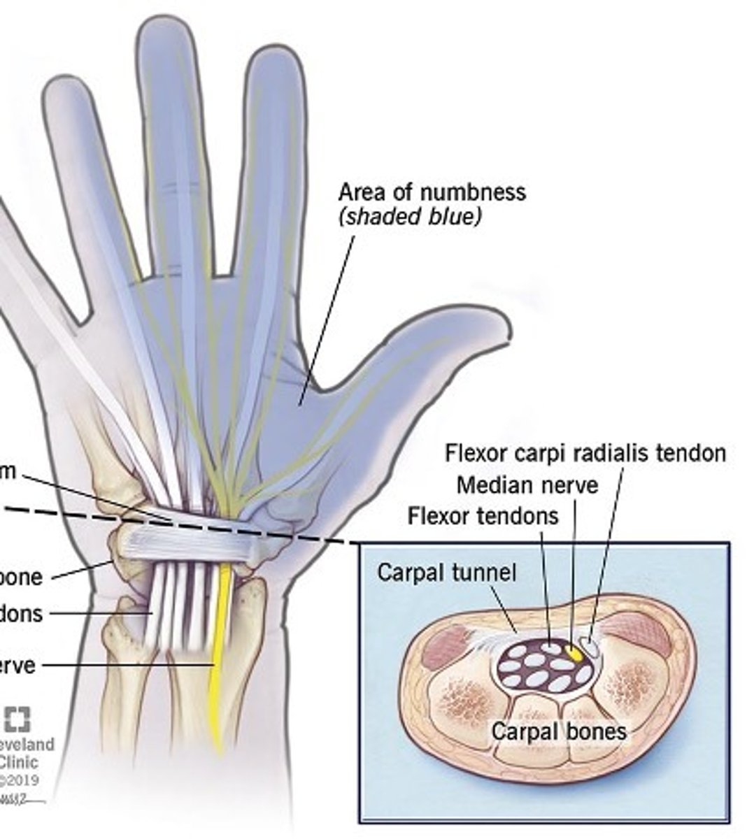 <p>Compression or entrapment neuropathy</p>