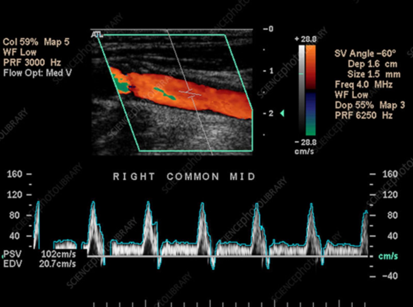<p>Carotid Duplex Study</p><p>- Evaluates for possible sclerotic plaques → microemboli</p>