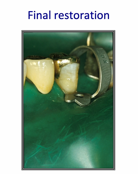 <ul><li><p>after air blowing - the layer of adhesive becomes thicker&nbsp;</p></li><li><p>controlling some of these resins may not be as straightforward as you may assume&nbsp;</p></li></ul><p></p>