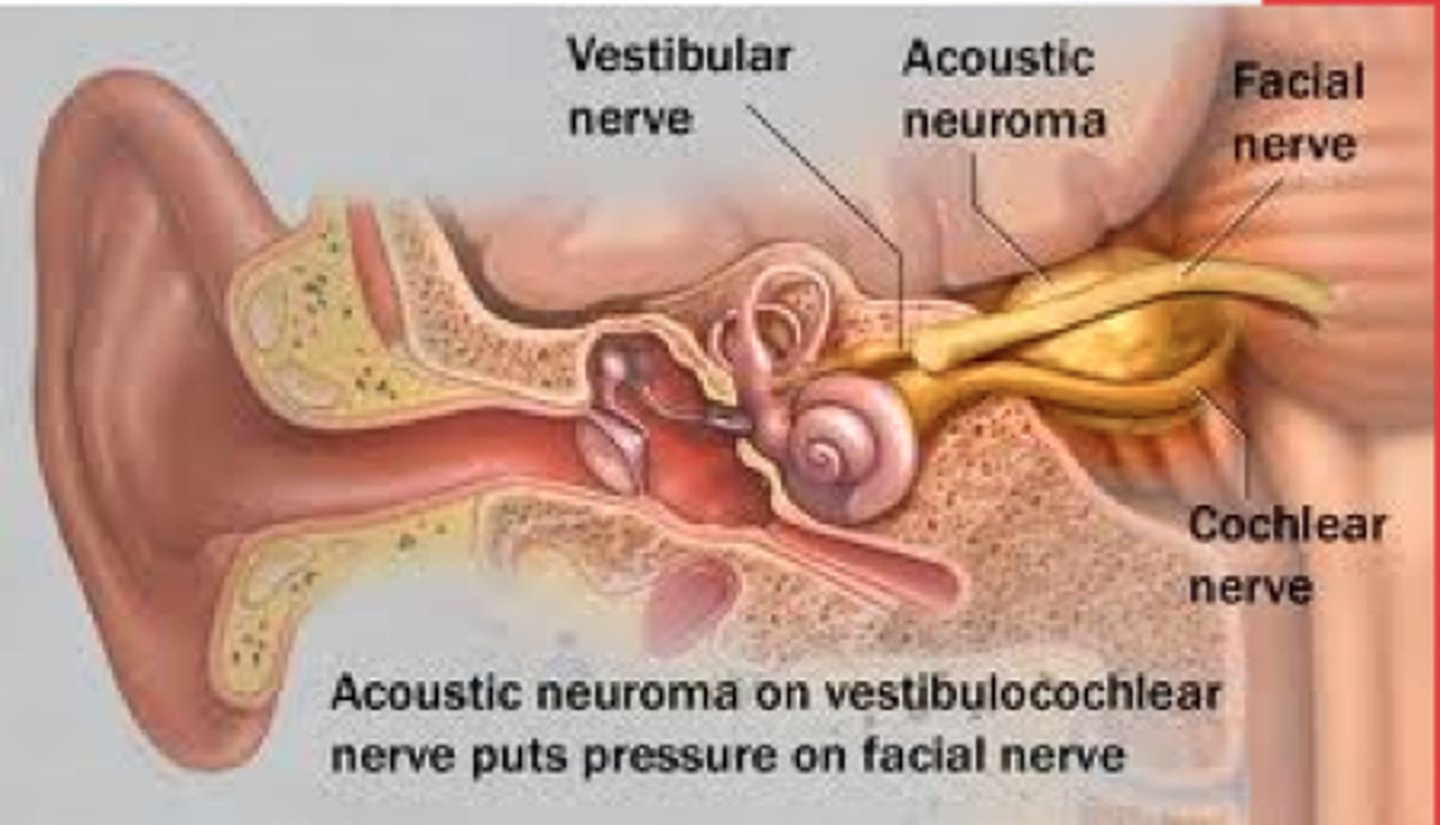 <p>benign tumor on the auditory nerve (8th cranial nerve) that develop from the shealth of schwann cells. Causes vertigo, tinnitus, and hearing loss</p>