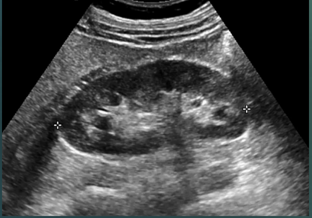 <p>Less echogenic. </p>