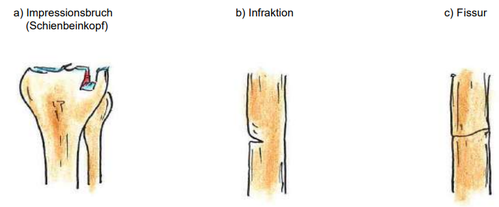 <p>a) Impressionsbruch</p><p>b) Infraktion</p><p>c) Fissur</p>