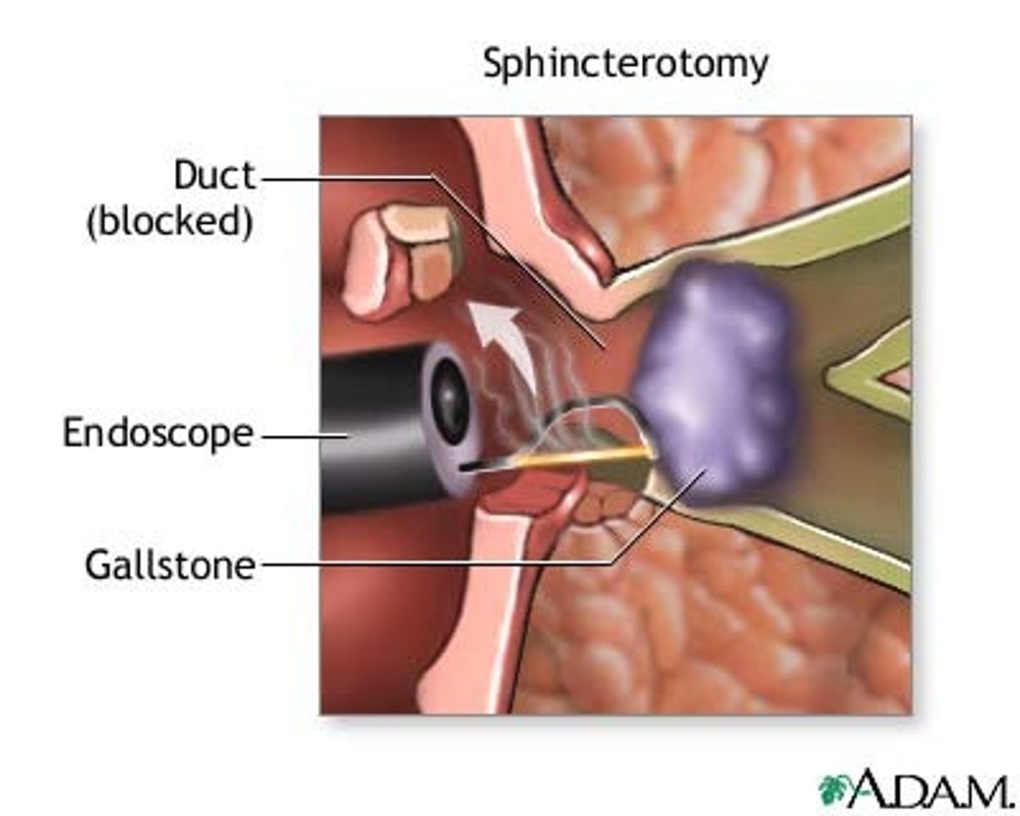<p>(remove common bile duct/Stone)</p><p>If caused by gallstones</p><p>Opens sphincter of Oddi</p>