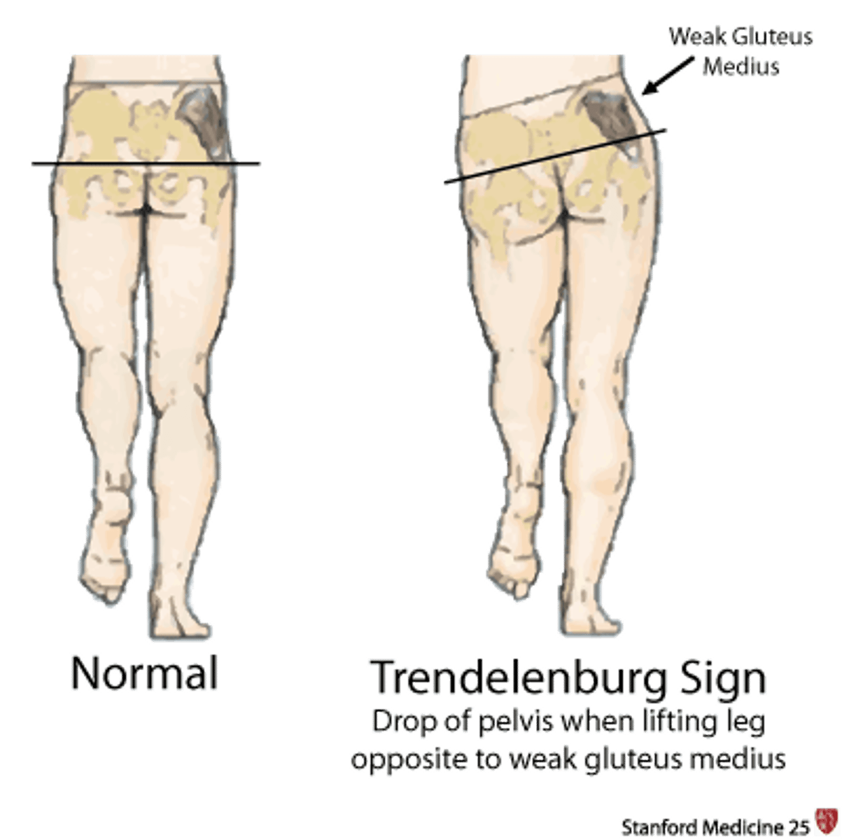 <p>gait pattern that denotes gluteus medius weakness</p><p>*hip drop toward the non-affected side</p><p>ex. drop L hip w/ R glut med weakness</p>