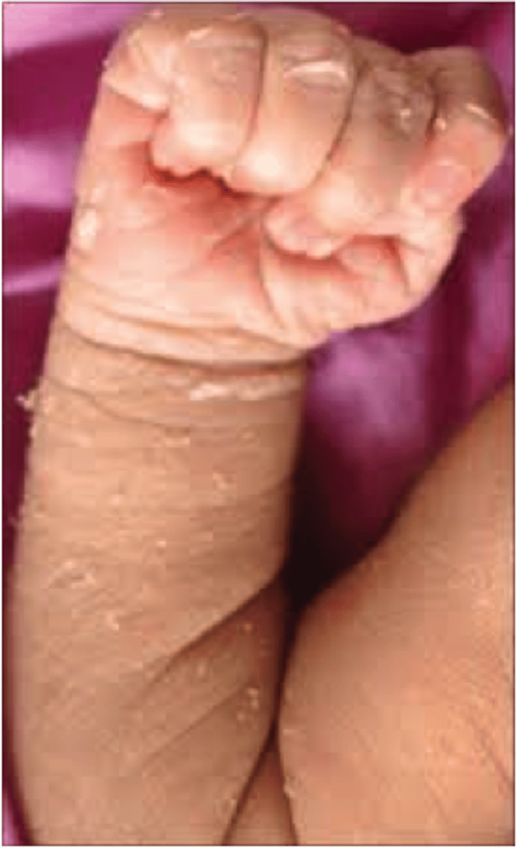 <p>peeling/flaking skin, more common in post term kiddos</p>