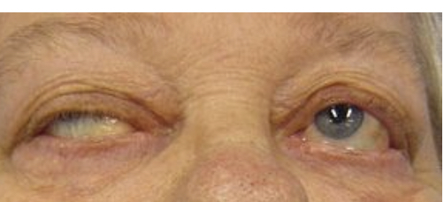 <ul><li><p>The blockage of receptors causes no contraction in the muscle, which makes weakness</p></li><li><p>Progressive weakness</p></li><li><p>Ptosis</p></li><li><p>Diplopia - seeing double</p></li><li><p>Dysphagia - difficulty swallowing</p></li><li><p></p></li></ul>