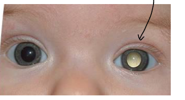 <p>cat’s eye reflex</p>