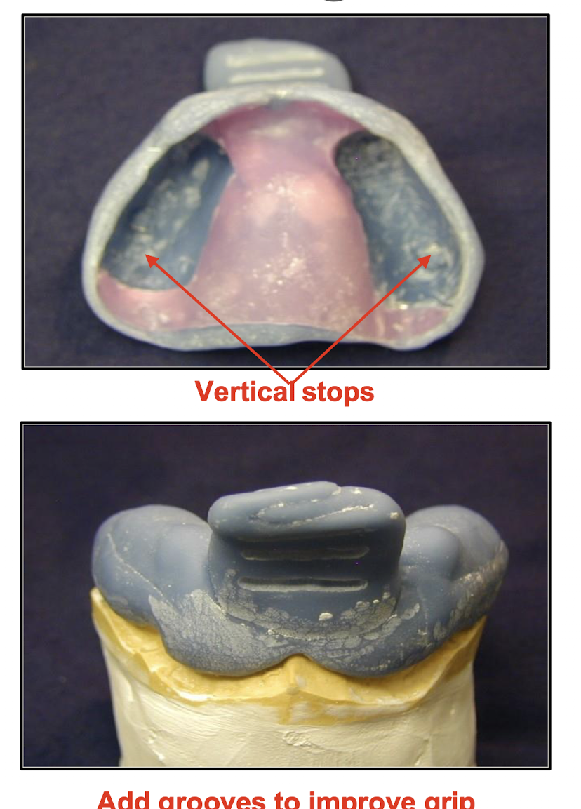 <ol start="16"><li><p>trim excess a the borders and smooth any sharpness (add grooves to&nbsp;improve grip)</p></li><li><p>Remove the wax and aluminum foil only on the teeth. The rest of the wax should be maintained during border molding and removed only before taking final impression.</p></li></ol><p></p>