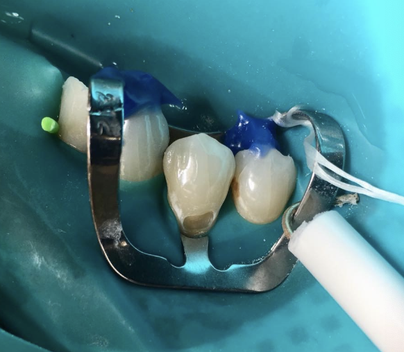 <p>What does airway protection do?</p>