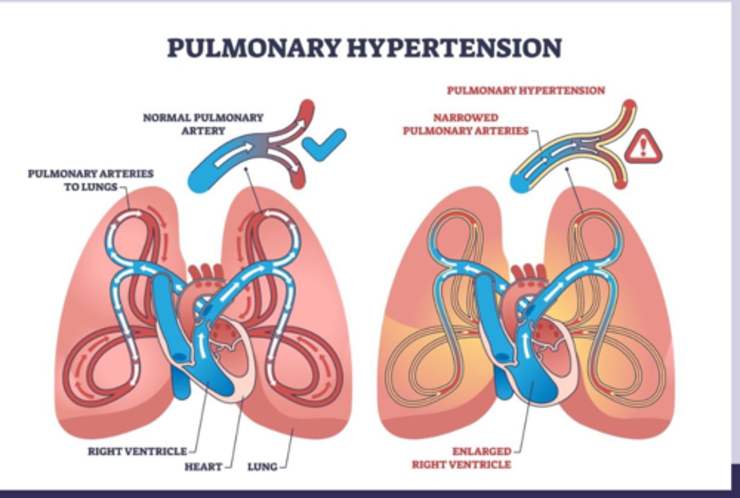 <p>-increased pulmonary vascular resistance due to vasocontriction, remodeling, thrombosis &gt; endothelial dysfunction with impaired vasodilation &gt; vascular remodeling with smooth muscle proliferation </p><p>-results in por pulmonale </p>