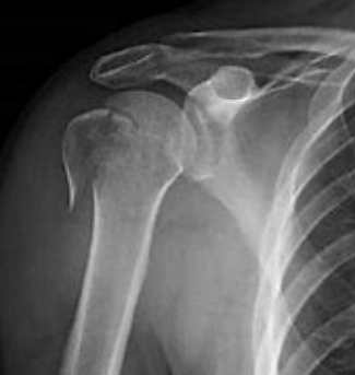 <p>What part of the humerus is fractured here? This type of fracture can result in issues with the rotator cuff muscles </p>