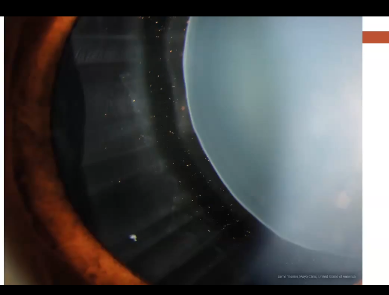 <p>zonules on slit lamp </p>
