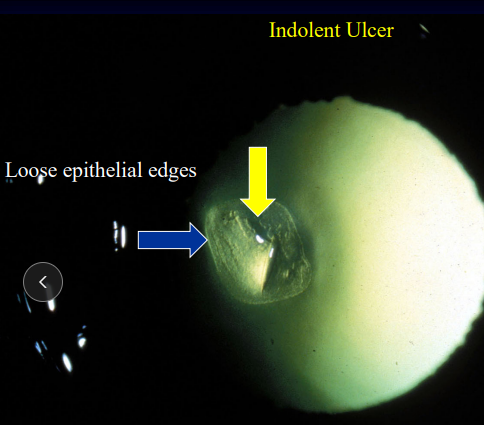 <ul><li><p><span style="background-color: transparent;"><strong><span>Et: </span></strong></span><span style="background-color: transparent; color: red;"><span>Recurrent epithelial erosion, failure of BM epithelial attachment</span></span></p></li><li><p><span style="background-color: transparent;"><strong><span>Sig:</span></strong><span> Old, </span></span><span style="background-color: transparent; color: rgb(176, 176, 176);"><span>boxers</span></span></p></li></ul><ul><li><p><span style="background-color: transparent;"><strong><span>Cs:</span></strong><span> Superficial, </span><strong><u><span>mild pain, loose epithelial borders, </span></u></strong><span> focal edema,</span></span><span style="background-color: transparent; color: red;"><span> mid aged/older dogs</span></span></p><ul><li><p><span style="background-color: transparent;"><strong><u><span>Chronic</span></u></strong></span></p></li></ul></li></ul><ul><li><p><span style="background-color: transparent;"><strong><span>Tx: Client education, </span></strong><span>debridement, keratotomy (100%), </span></span><span style="background-color: transparent; color: red;"><span>tetracycline(topical)</span></span><span style="background-color: transparent;"><span>, </span></span><span style="background-color: transparent; color: red;"><span>diamond burr (93%)</span></span></p><ul><li><p><span style="background-color: transparent;"><span>Recheck every 7-14 days, </span><u><span>long term treatment</span></u></span></p></li></ul></li></ul><p></p>