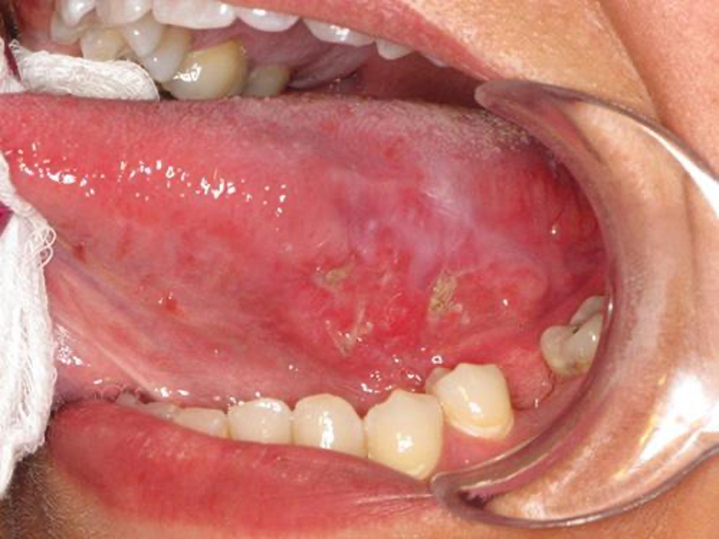 <p>A lesion is found on the lateral border of the tongue and appears ulcerated and indurated. What is the MOST likely diagnosis?</p>