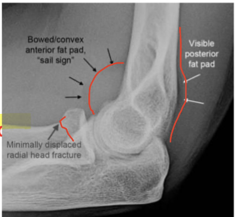 <p>What are fat pad signs associated with</p>