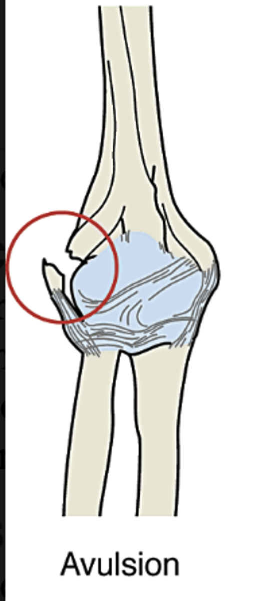 <p>a piece of bone is torn away from the main bone while still attached to a ligament or tendon</p>