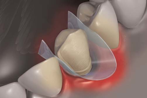 <p>what is this dental instrument called?</p>