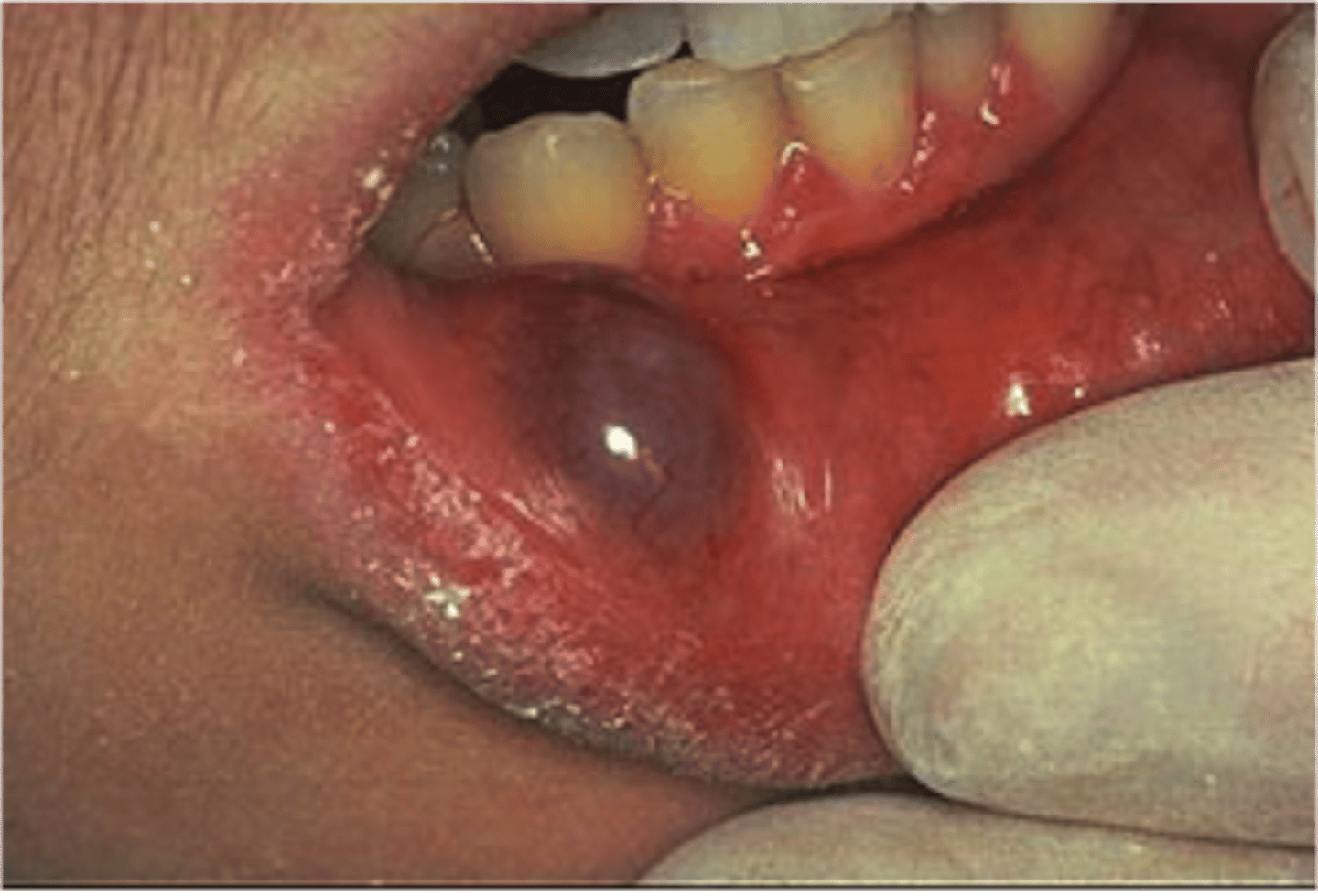 <p>bluish/pink/clear accumulation of salivary gland secretion in CT due to severed duct</p><p>• common location: mandibular labial mucosa</p><p>• histology: mucus + granulation tissue</p>