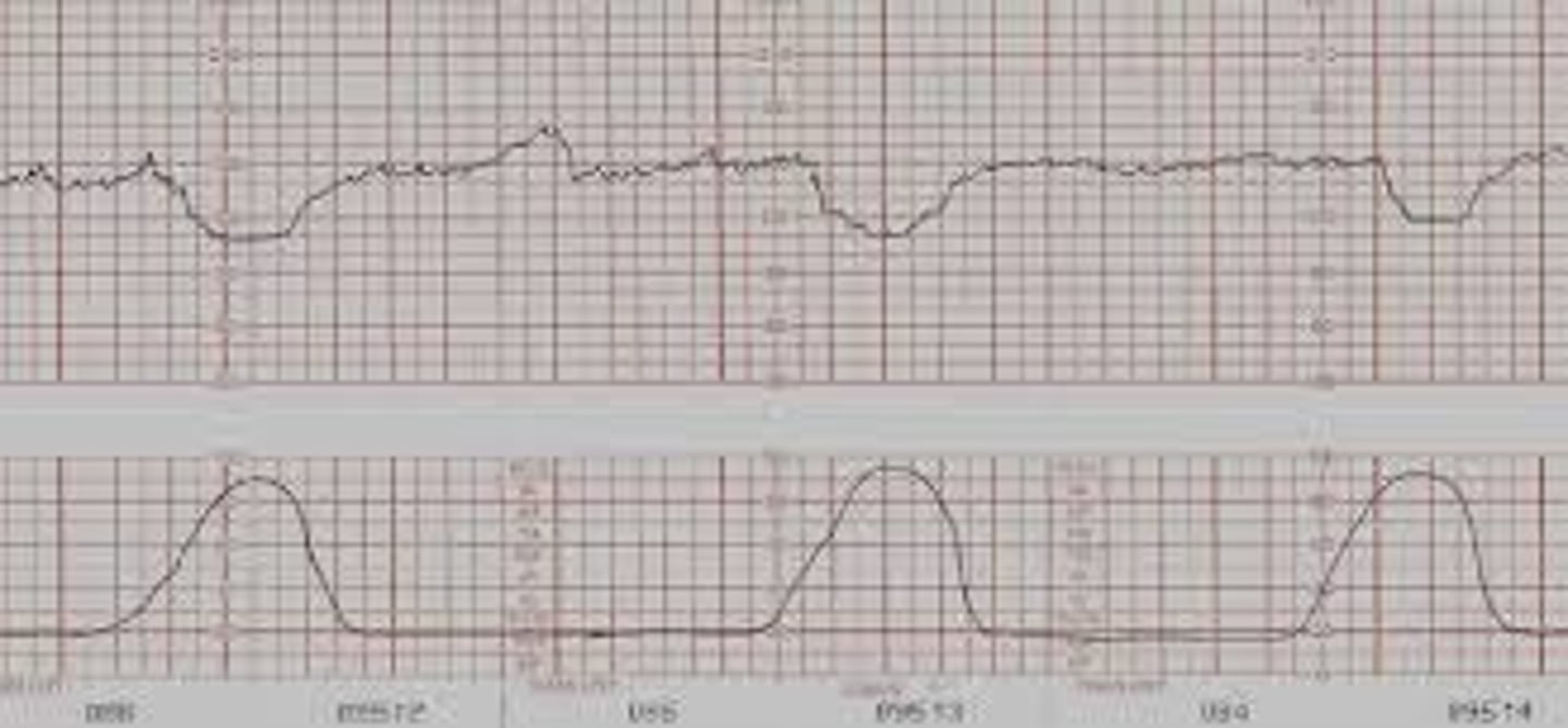 <p>Caused by head compression usually as head gets lower in cervix: typically a good sign</p><p>- Mirror image of contraction</p>