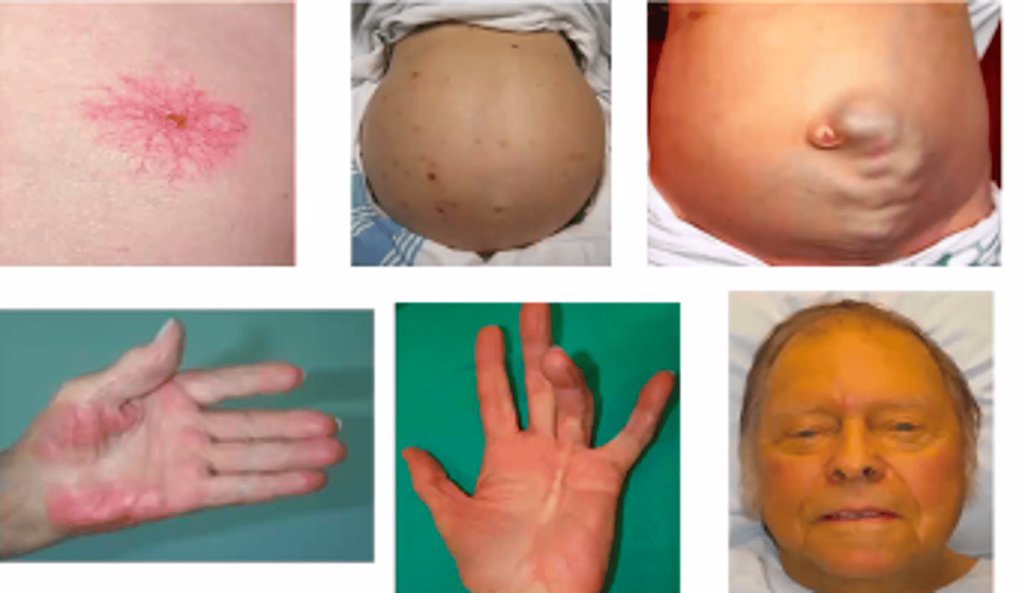 <p>1. Jaundice</p><p>2. Hepatic Encephalopathy</p><p>3. Variceal Bleeding</p><p>4. Ascites</p>