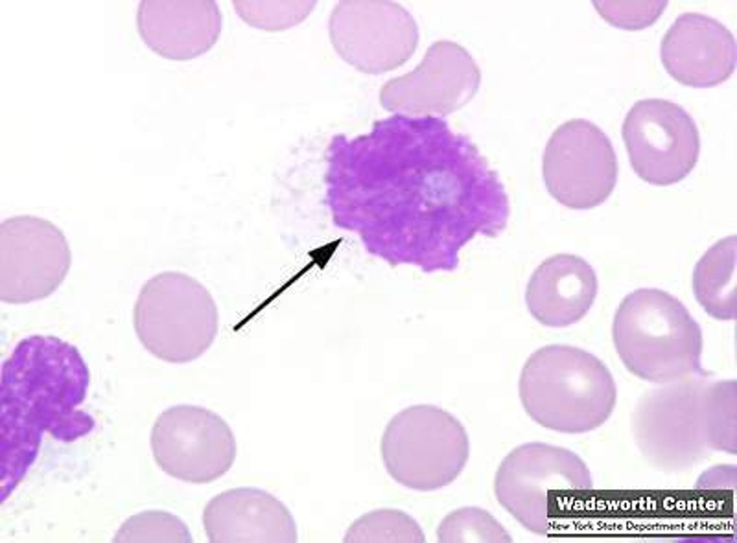<p>reflects the fragility of lymphocytes</p>
