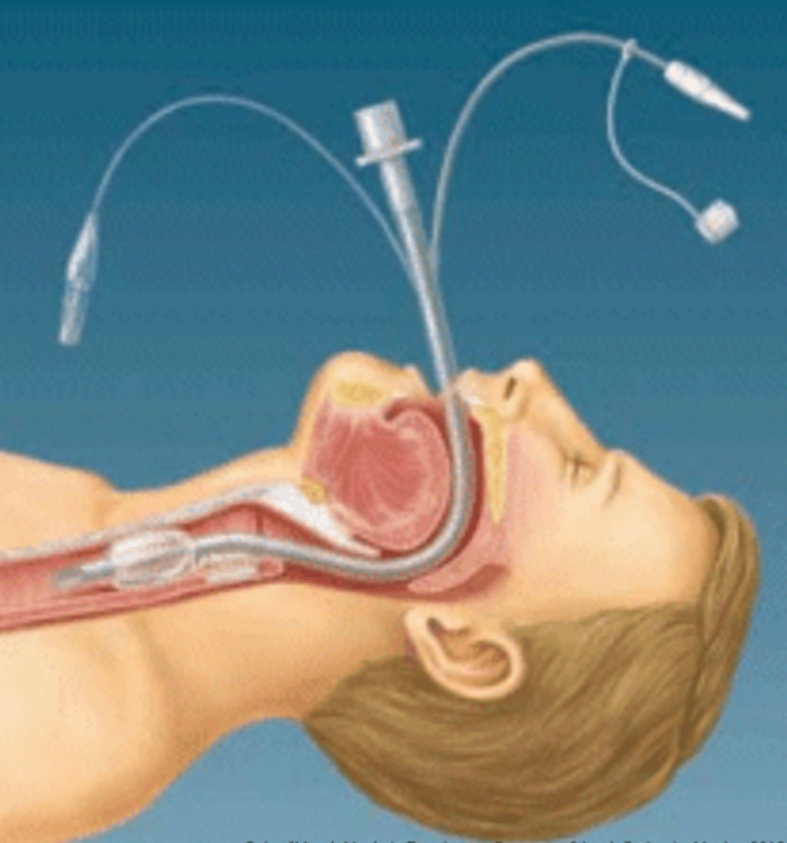 <p>Tube inserted into trachea for airway protection and ventilation.</p>