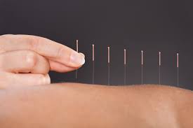 <p>acupuncture</p>