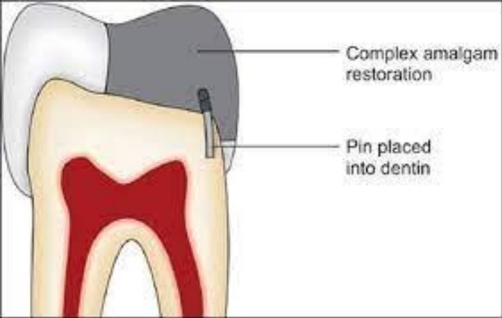 <p><strong>Vital teeth</strong></p><p><strong>ALWAYS in</strong> <strong>dentin</strong> NEVER enamel or pulp. (cemented or driven in)</p>