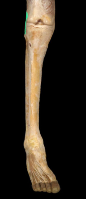 Connects lateral femoral condyle to head of fibula

limit rotation between femur and tibia