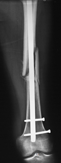 <ul><li><p>structures shown:</p><ul><li><p>distal 2/3 of femur</p></li><li><p>knee joint</p></li></ul></li><li><p>evaluation criteria:</p><ul><li><p>most of femur including knee joint for distal</p></li><li><p>no rotation of knee</p></li><li><p>adequate penetration</p></li><li><p>orthopedic appliance in its entirety</p></li></ul></li></ul><p></p>