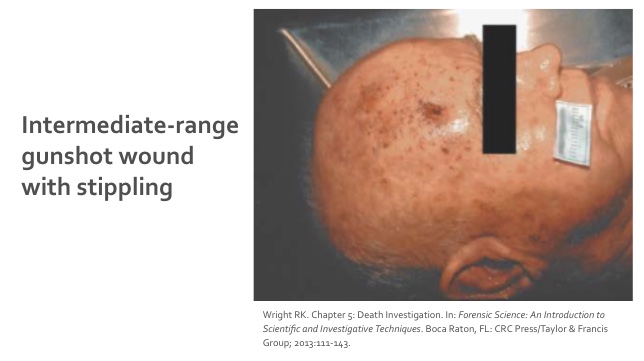 <p><strong>intermediate-range gunshot wounds</strong></p>