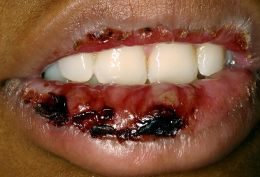 <ul><li><p>Mild</p></li><li><p>Young, Male &gt; female</p></li><li><p>Starts on skin of extremities, oral lesions appear</p></li><li><p>Crusting on lips</p></li><li><p>Usually due to herpes (HSV)</p></li></ul><p></p>