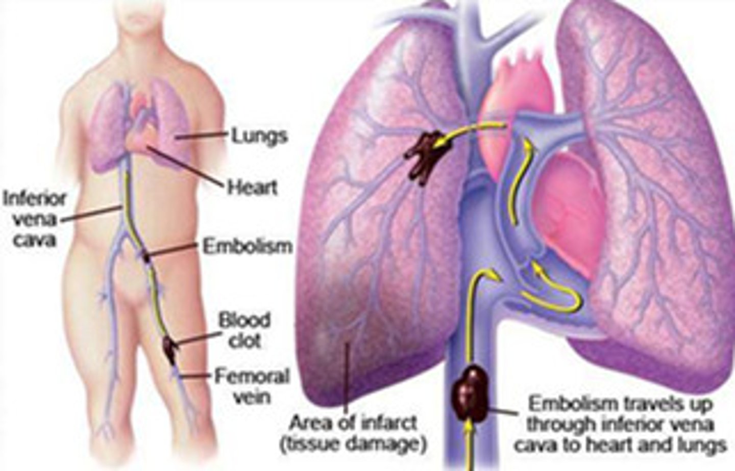 <p>A blood clot that breaks off from a large vein and travels to the blood vessels of the lung, causing obstruction of blood flow.</p>
