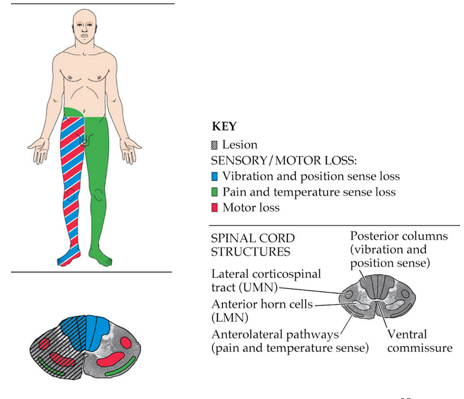 <p>Hemicord lesion causing ipsilateral motor weakness and loss of proprioception with contralateral loss of pain and temperature</p>