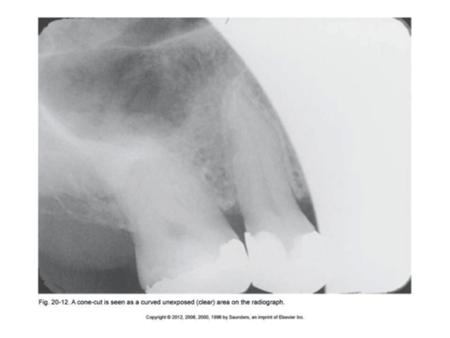 <p>bisecting technique when a beam alignment device is not used</p><p>a clear or white unexposed area</p><p>PID was not directed at the center of the receptor</p><p>make sure PID is directed over the center of the receptor</p>