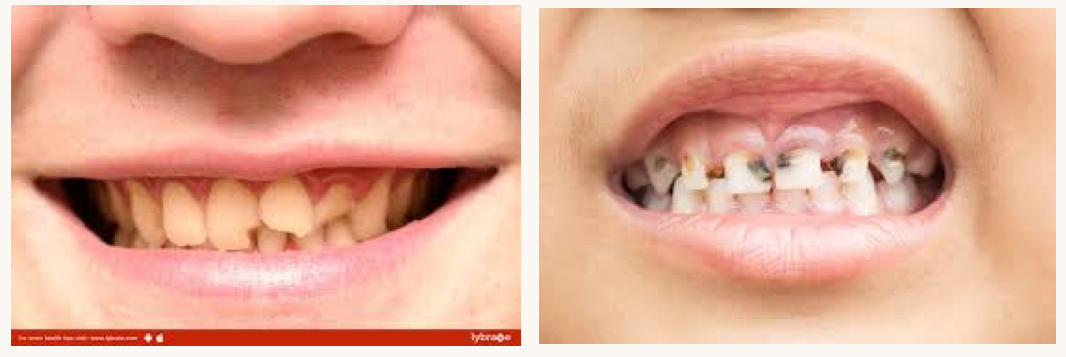 <p>what is this condition and what mineral is this person likely deficient in?</p>