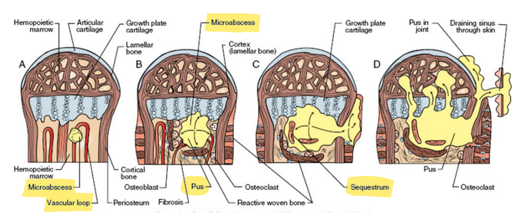 <ul><li><p>most common in young animals at <strong>metaphysis</strong></p></li><li><p>capillaries make sharp turn to join medullary veins → slower and less turbulent blood flow → embolus gets trapped → abscess → sequestrum </p></li></ul><p></p>