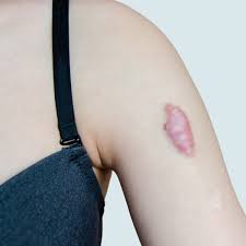 <p>keloid</p>
