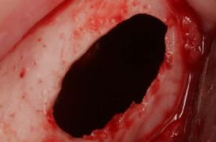 <p>What is another name for Traumatic Bone Cyst (TBC)?</p>